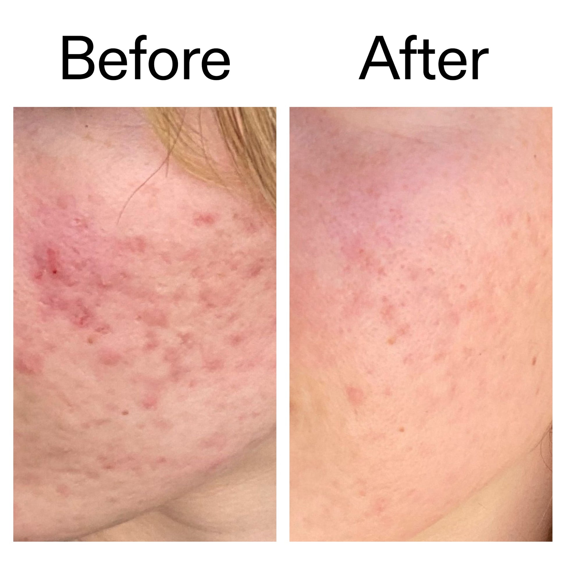 10-azelaic-acid-serum-for-redness-relief-g6 Azealic_Acid_Serum_B_A_Ppage_2000_x_2000.jpg