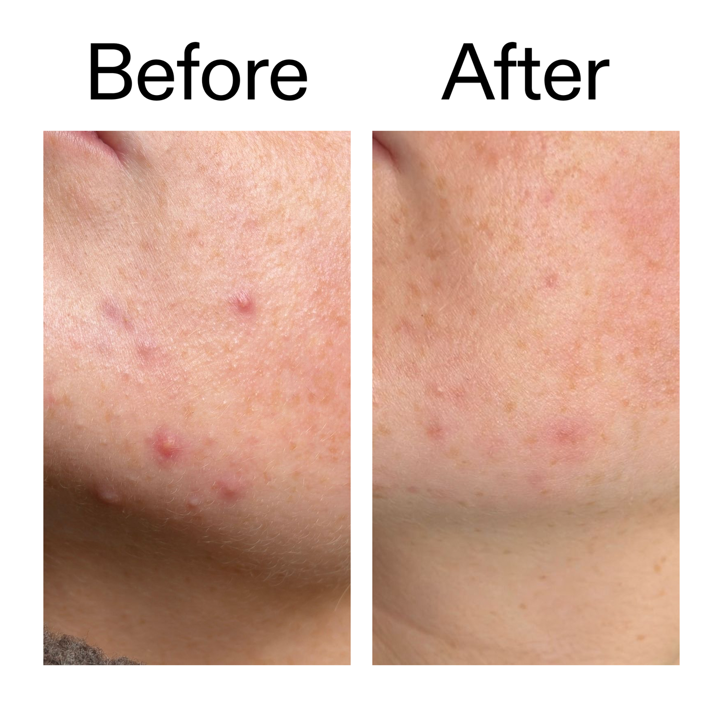 10-azelaic-acid-serum-for-redness-relief-g6 B_A_1_PPAGE.png