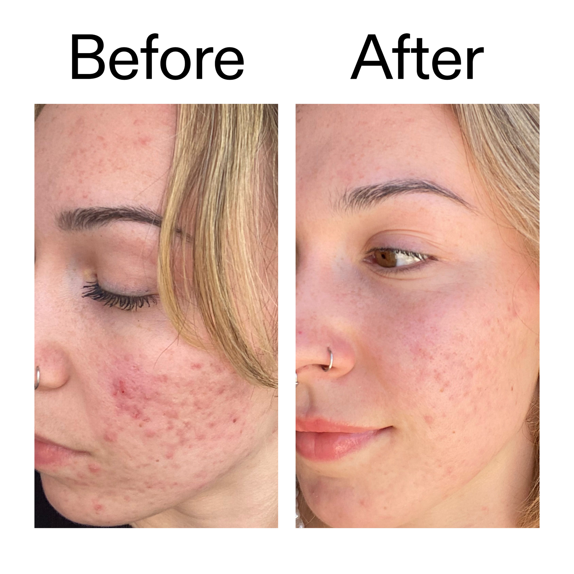 10-azelaic-acid-serum-for-redness-relief-g6 B_A_2_PPAGE.png