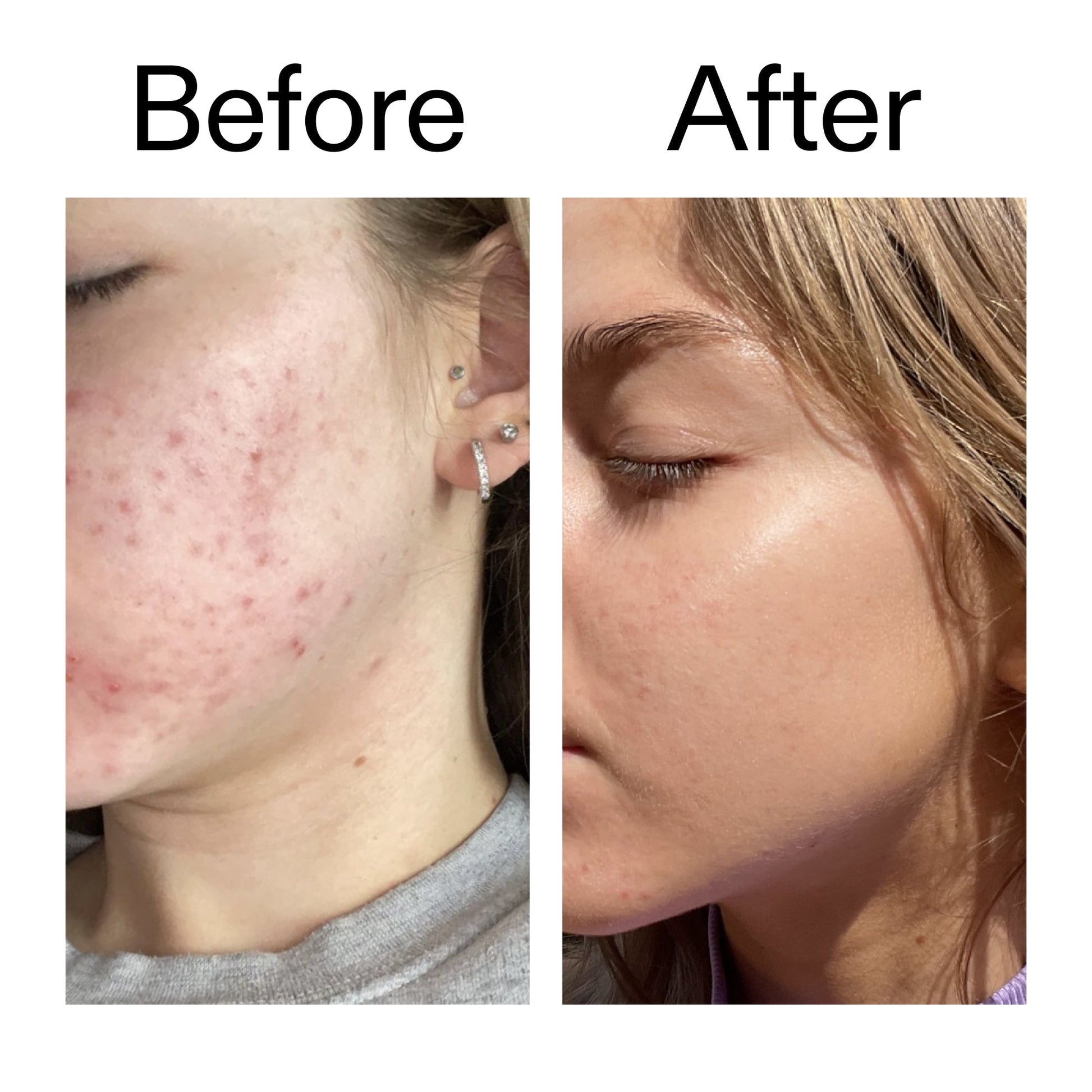 beta-hydroxy-acid-bha-serum-o4 Beta_Hydroxy_Acid_Serum_Before_After_2000x2000_96fda3e5-938d-49ef-bcf2-a0fa6ece4e2c.jpg