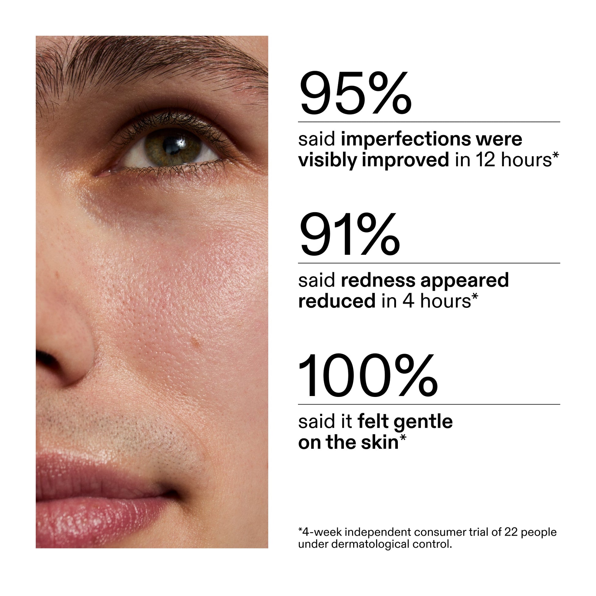 succinic-acid-acne-treatment-n9 CA_Succinic_Acid_Treatment_key_Claims_2000x2000_db91b0f1-7f29-4bfe-bb16-63a47f500960.jpg