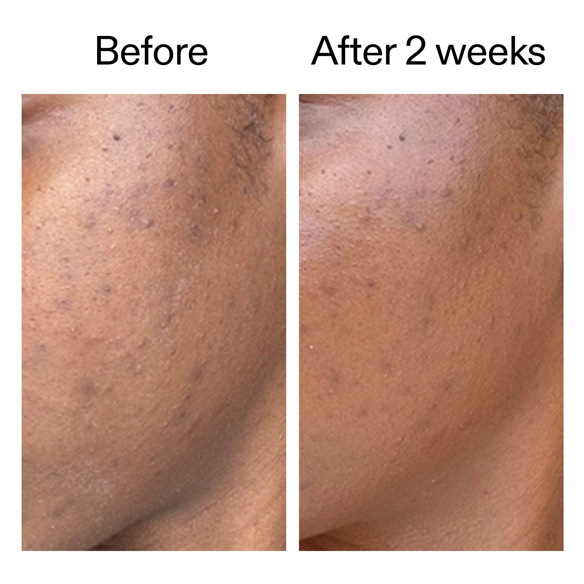 360-acne-clearing-duo-d1 DIOICB_A2000x2000.jpg