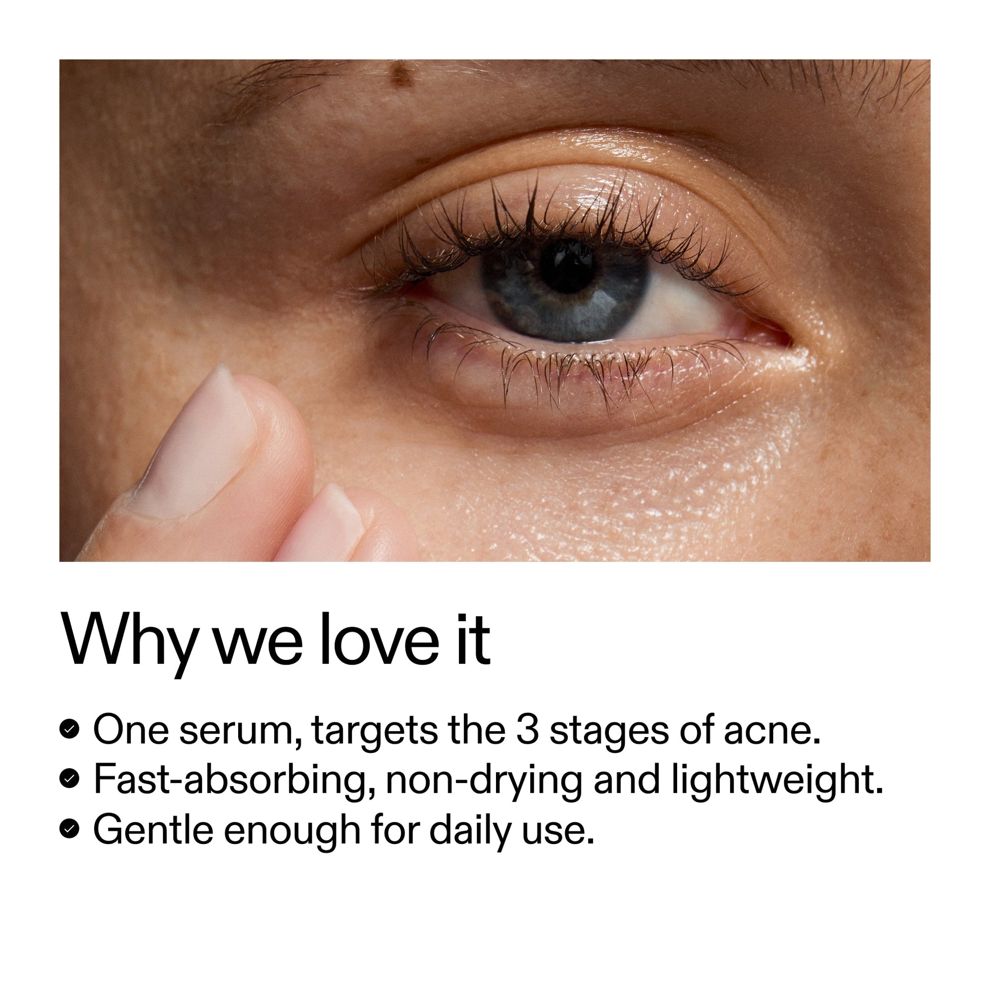 360-acne-clearing-serum-u5 Dioic_Whyweloveit_2000x2000_175aafd3-0cbe-403a-b317-a8362881bfe2.jpg