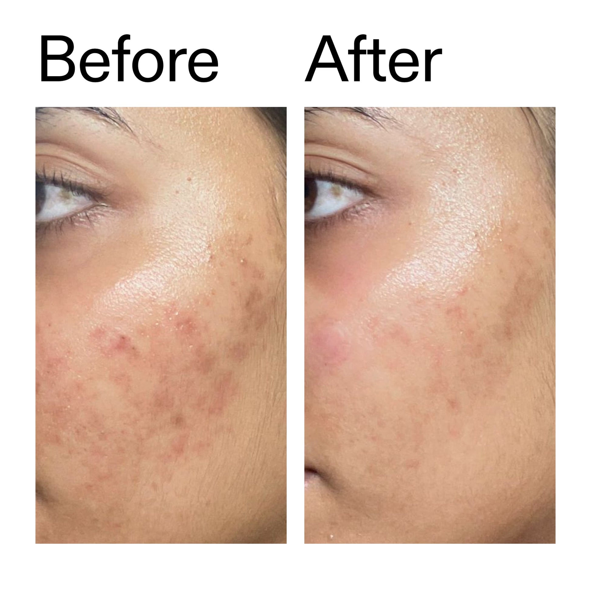 ectoin-hydro-barrier-serum-g2 Ectoin_Hydro-barrier_Serum__Before_After_2000x2000_34261920-d004-48d0-9c7b-8e1c15971bfd.jpg