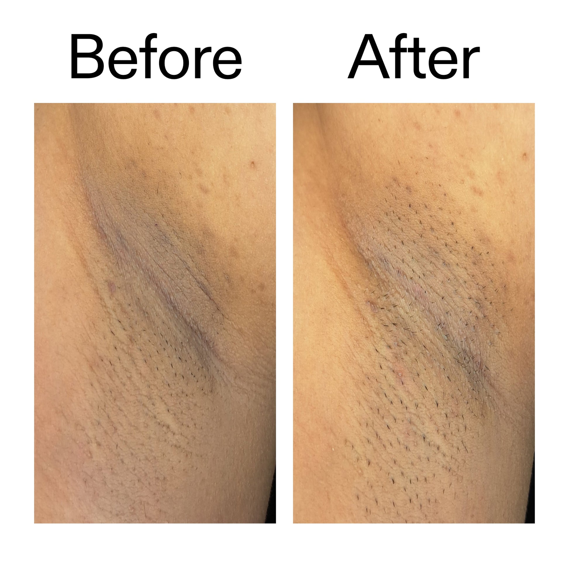 glycolic-acid-exfoliating-body-stick-d1 Glycolic_Acid_Exfoliating_Body_Stick_Before_After_V3_2000x2000_ea919cd9-1439-4a46-82a0-76200eb5bb42.jpg