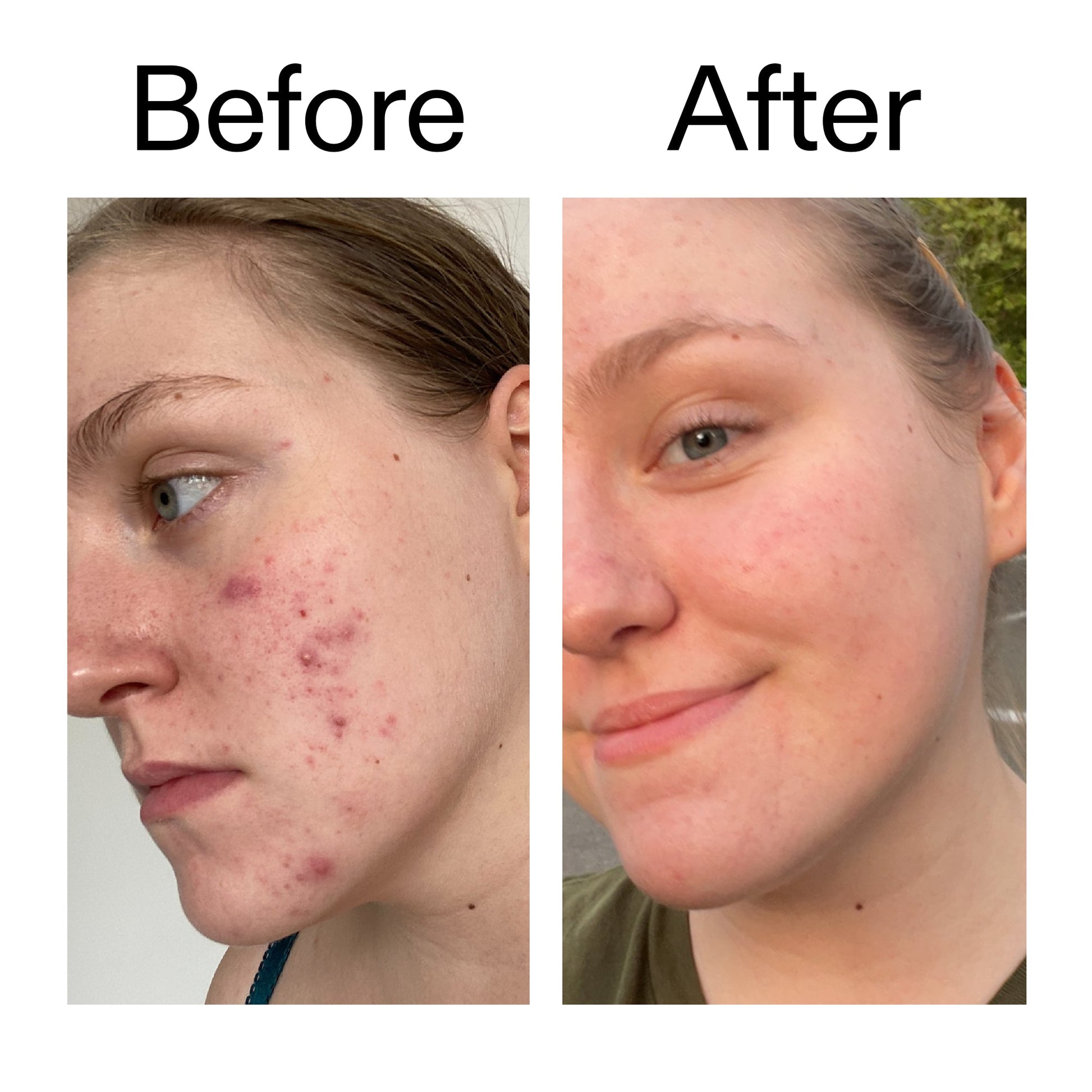 glycolic-acid-toner-b0 Glycolic_Acid_Toner_Before_After_2000x2000_49f0b9f7-e71b-4b2e-a8f8-2ea4b73247bb.jpg