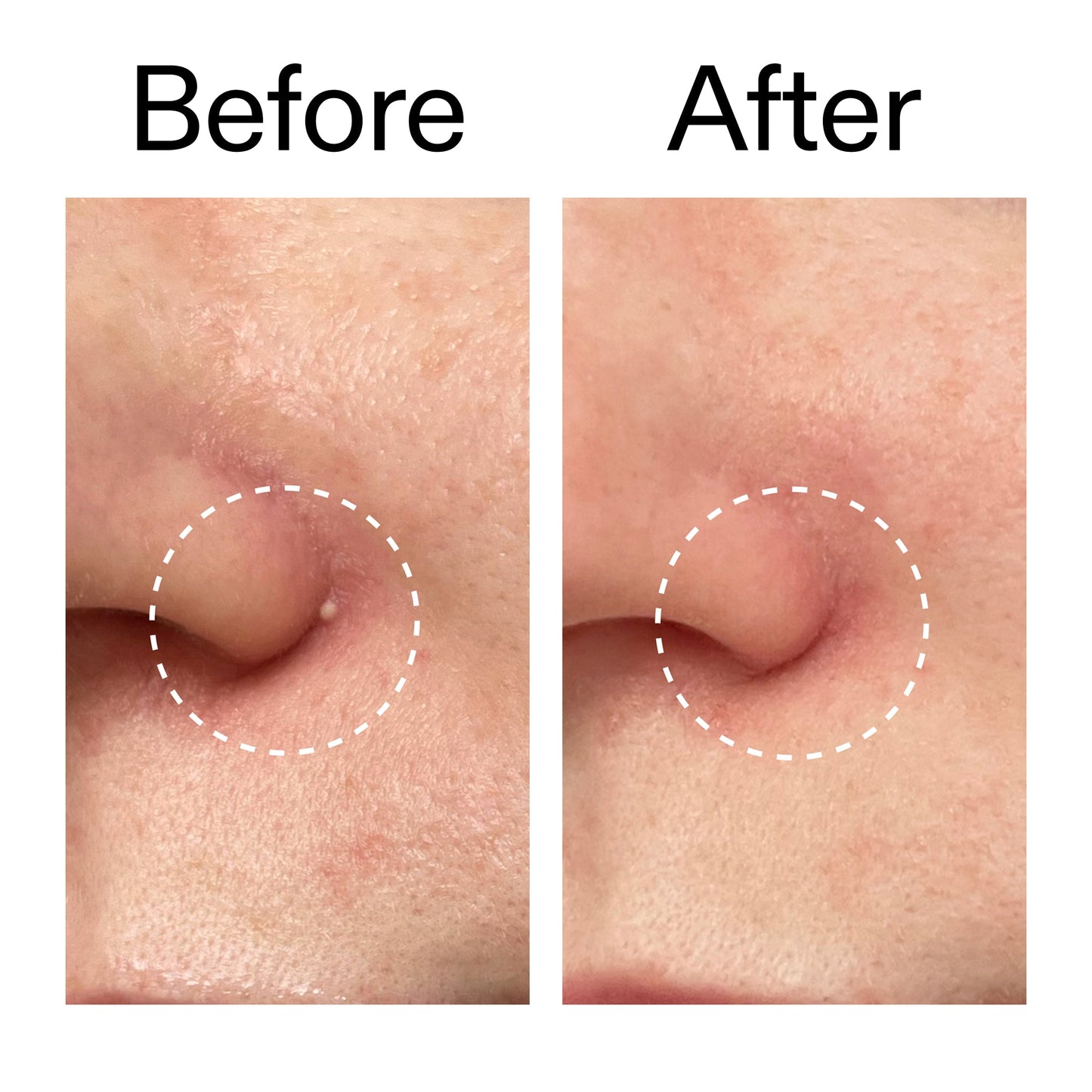 hydrocolloid-invisible-pimple-patches-pack-of-44-u0 Hydrocolloid_Invisible_Pimple_Patches_Before_After_2000x2000_b02aa37b-c78a-4682-91de-9135af5bb7df.jpg