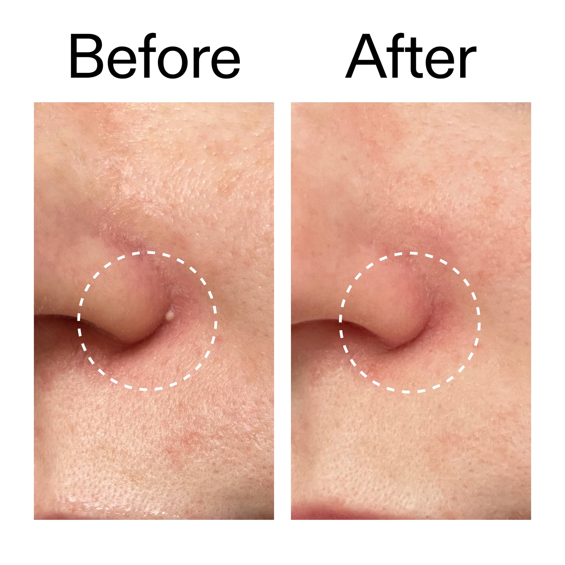 hydrocolloid-invisible-pimple-patches-pack-of-44-u0 Hydrocolloid_Invisible_Pimple_Patches_Before_After_2000x2000_b02aa37b-c78a-4682-91de-9135af5bb7df.jpg