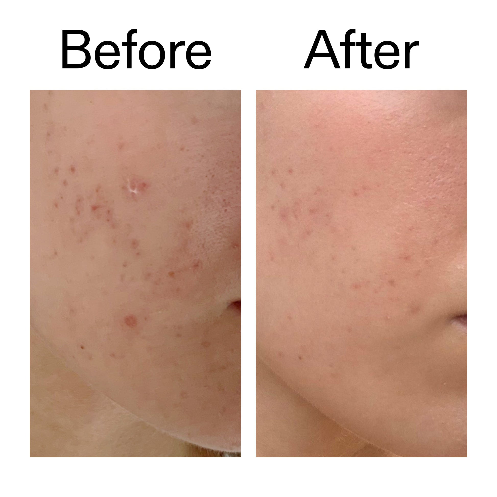 mandelic-acid-treatment-a4 Mandelic_Acid_Treatment_Before_After_2000x2000_4885ac6e-c5d7-4279-a72a-1417af7dce35.jpg