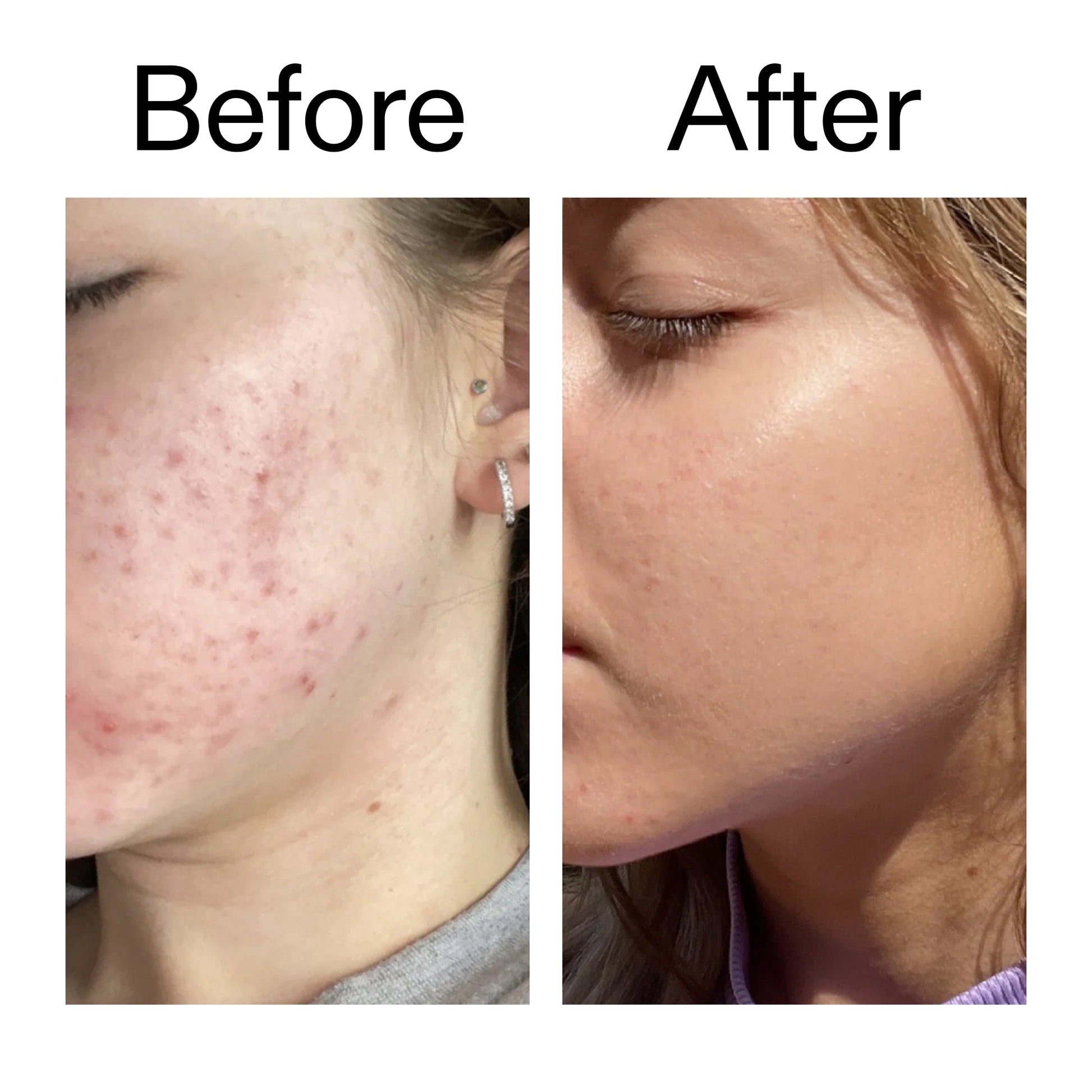 10-niacinamide-serum-duo-l9 Niacinamide_Serum_Before_After_2000x2000_bde32455-9e7d-448e-b053-bef41504f0a9.jpg