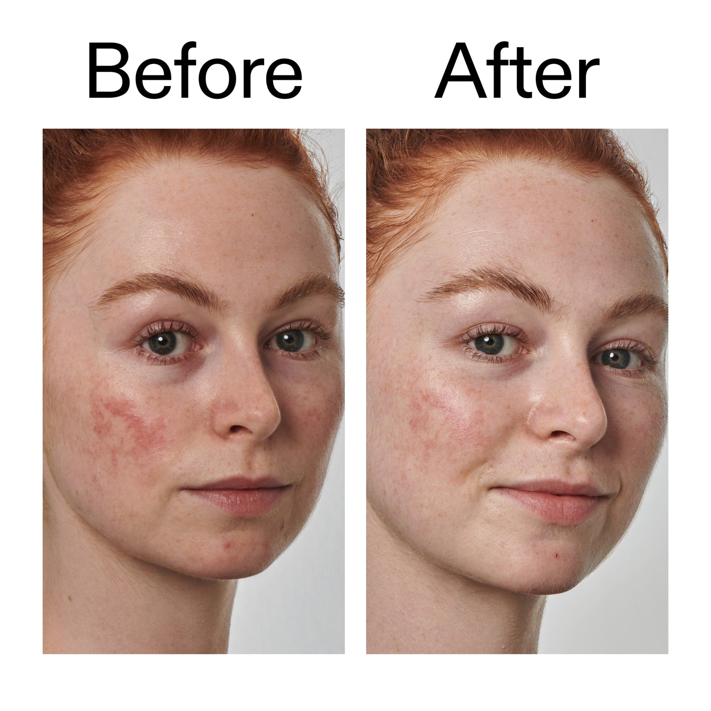 10-azelaic-acid-serum-for-redness-relief-g6 Redness_Relief_Serum_Before_After_2000x2000_3334dc9a-cce9-4e00-8aec-7ad89ca051f2.jpg