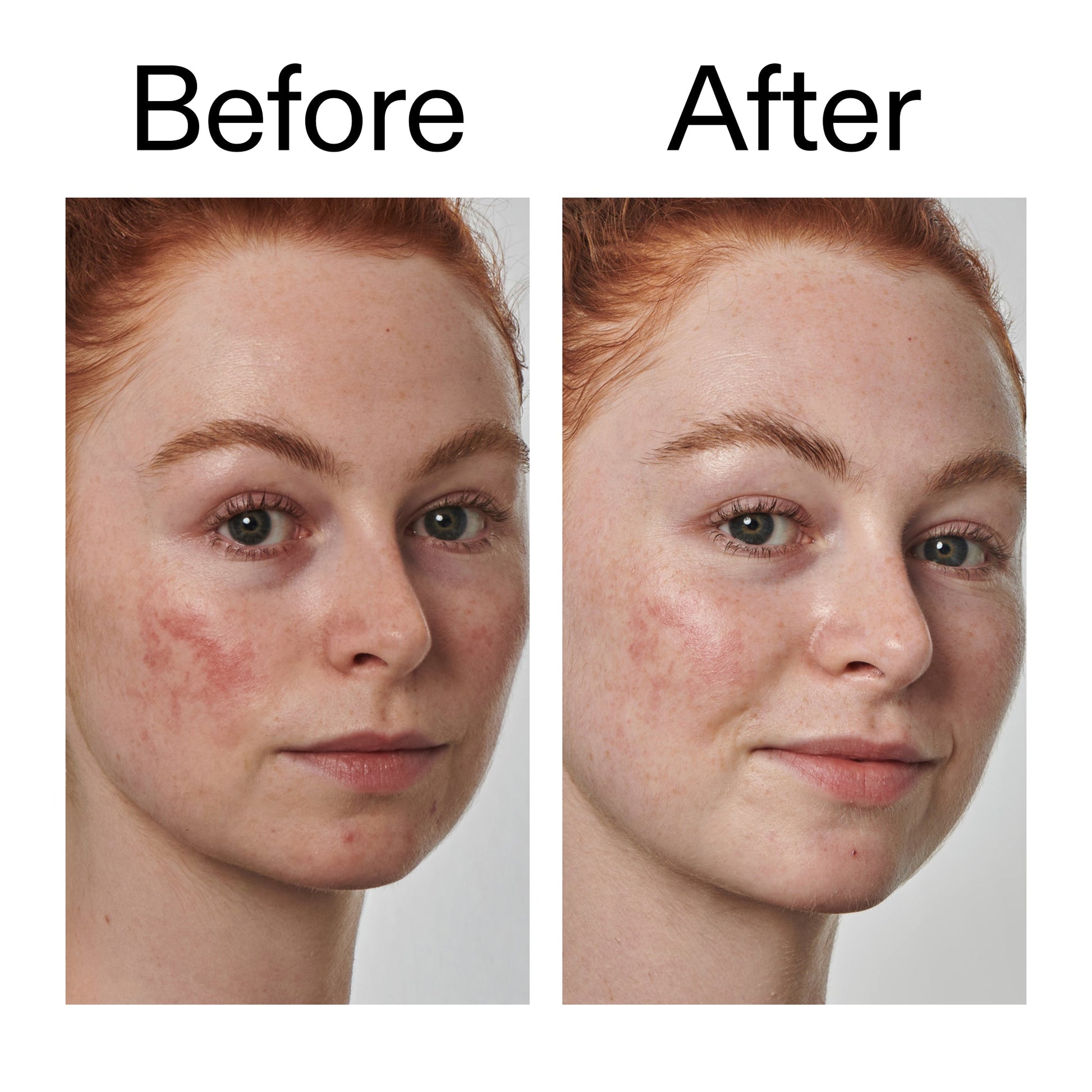 10-azelaic-acid-serum-for-redness-relief-g6 Redness_Relief_Serum_Before_After_2000x2000_3334dc9a-cce9-4e00-8aec-7ad89ca051f2.jpg
