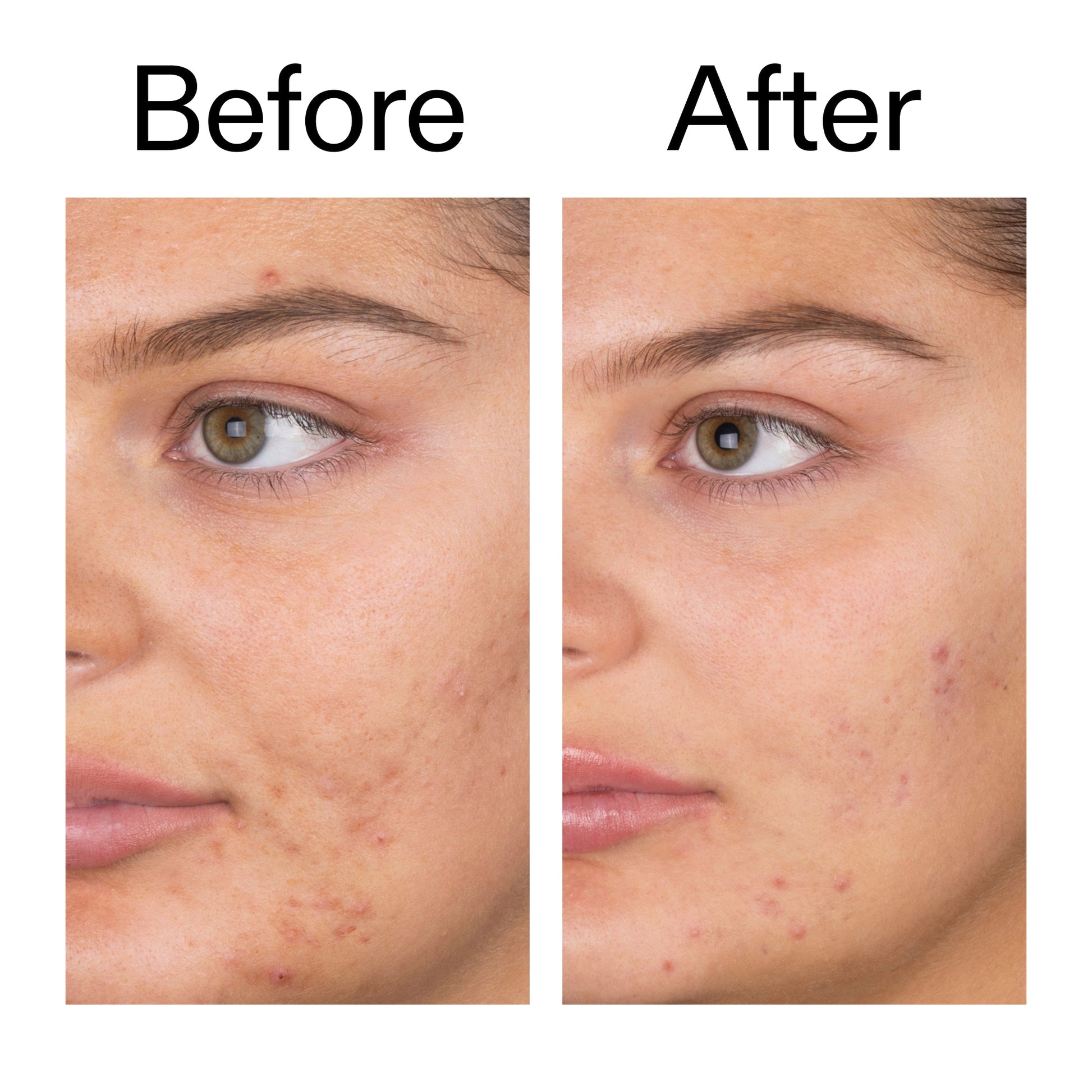 salicylic-acid-cleanser-150ml-i3 Salicylic_Acid_Cleanser_-_150ml_Before_After_2000x2000_e7230494-853f-4b07-82b1-27669104c995.jpg