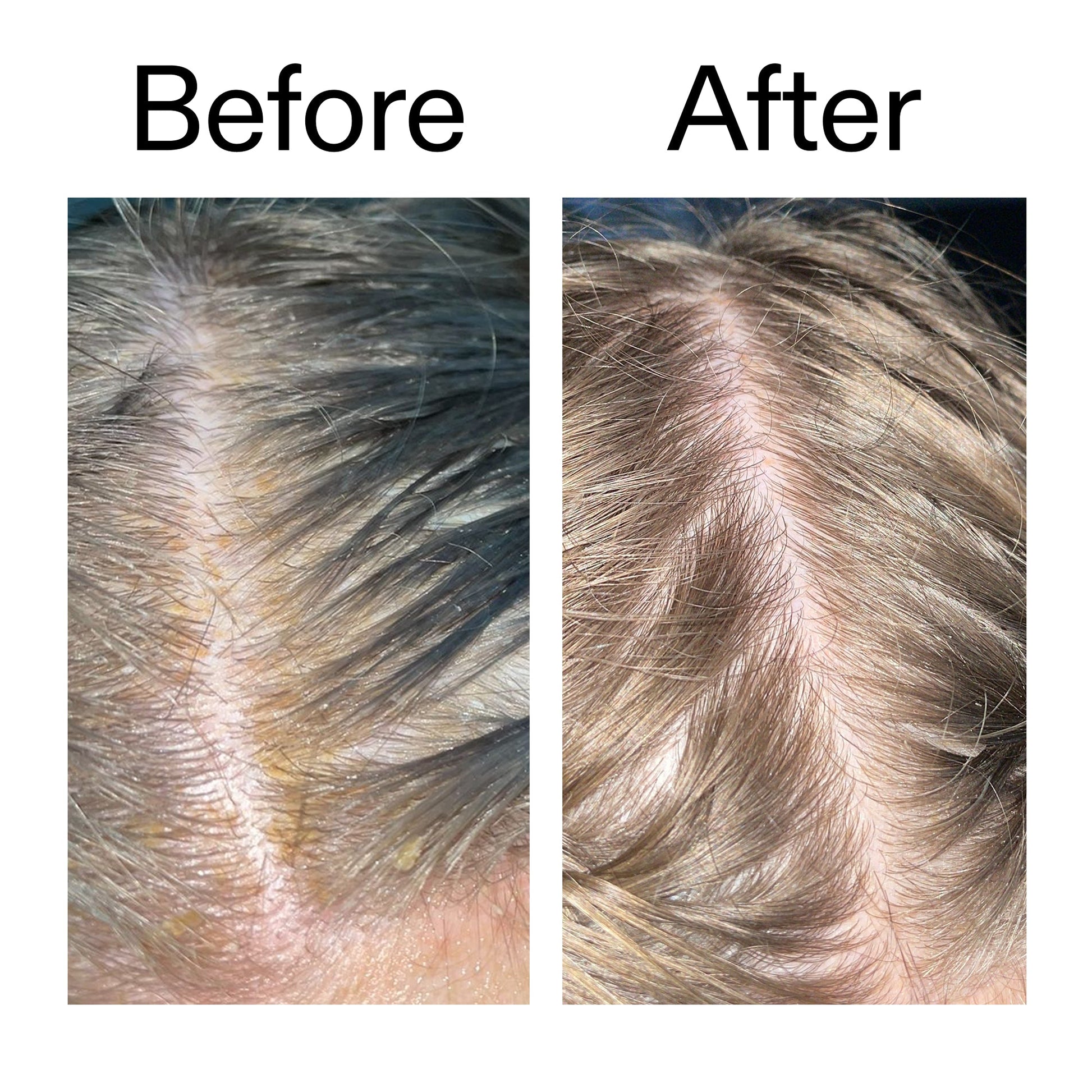 salicylic-acid-exfoliating-scalp-treatment-m3 Salicylic_Acid_Exfoliating_Scalp_Treatment_Before_After_2000x2000_e572a30f-057c-4a48-823b-1c09dc97f8d0.jpg