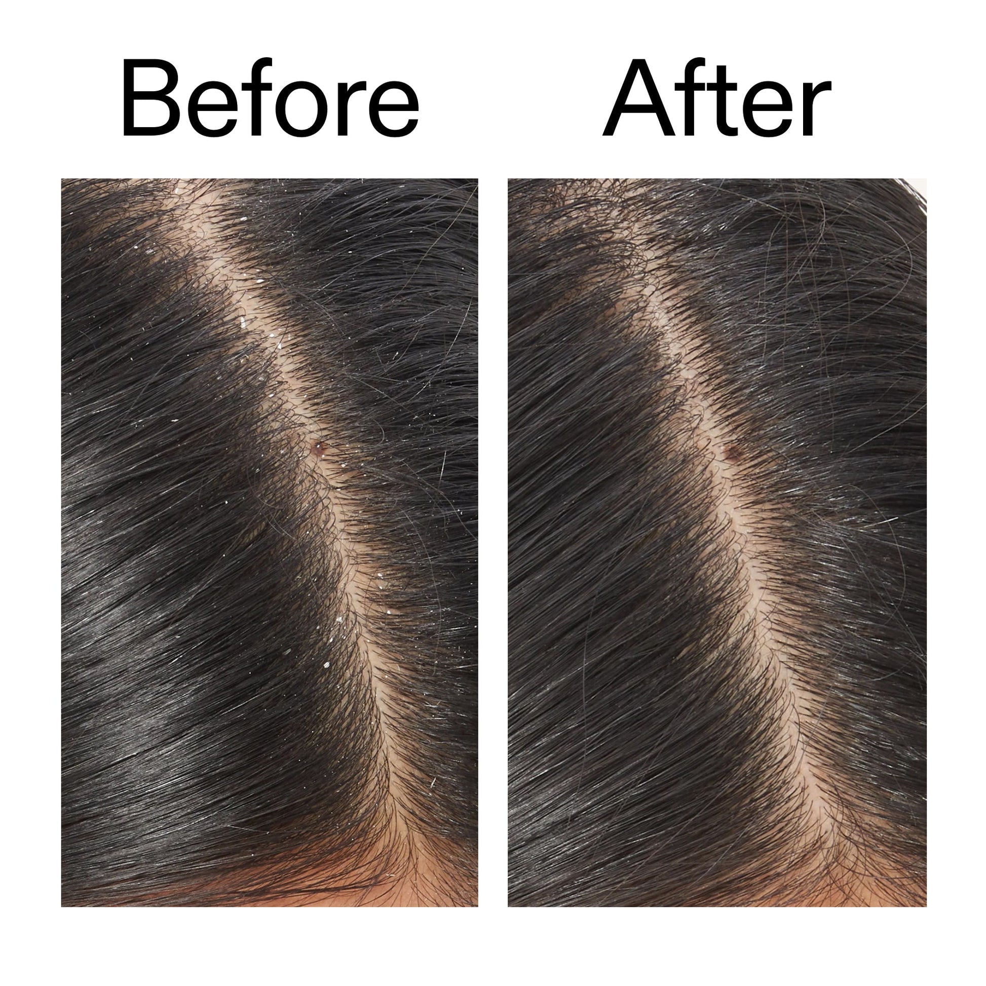 salicylic-acid-exfoliating-scalp-treatment-m3 Salicylic_Acid_Exfoliating_Scalp_Treatment_Before_After_V2_2000x2000_02bd61ad-42bf-490b-b3e3-7e04b2e8a673.jpg
