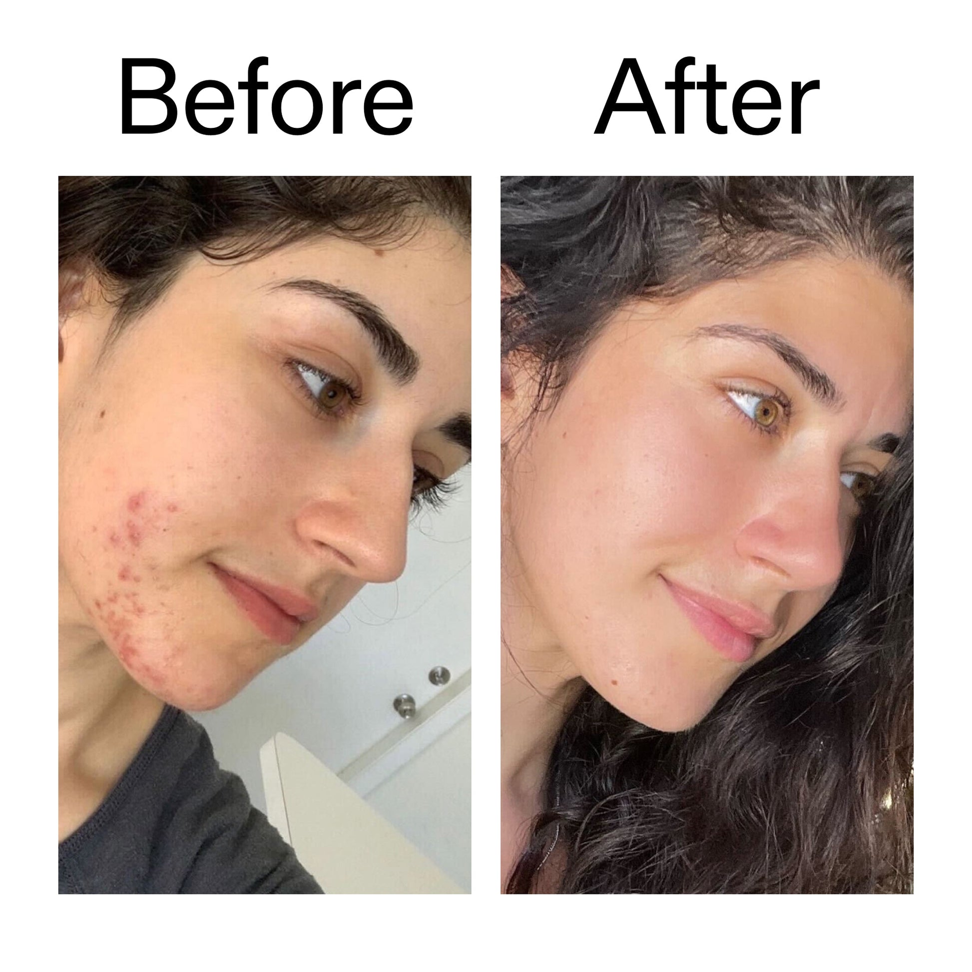 succinic-acid-acne-treatment-n9 Succinic_Acid_Treatment_Before_After_2000x2000_6a5f0054-2f58-4433-9314-0dc72c9bdd3b.jpg