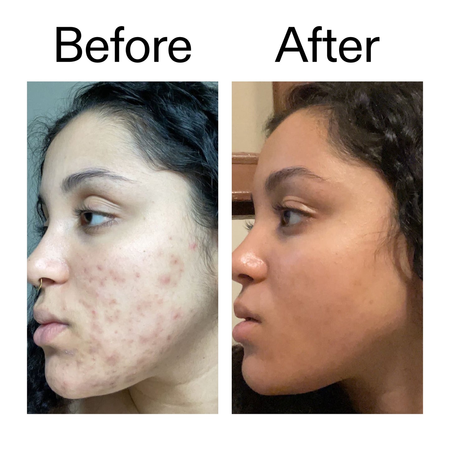 tranexamic-acid-serum-c4 Tranexamic_Acid_Serum_Before_After_2000x2000_98ebc8be-77b0-4843-8a22-90790ebe918b.jpg